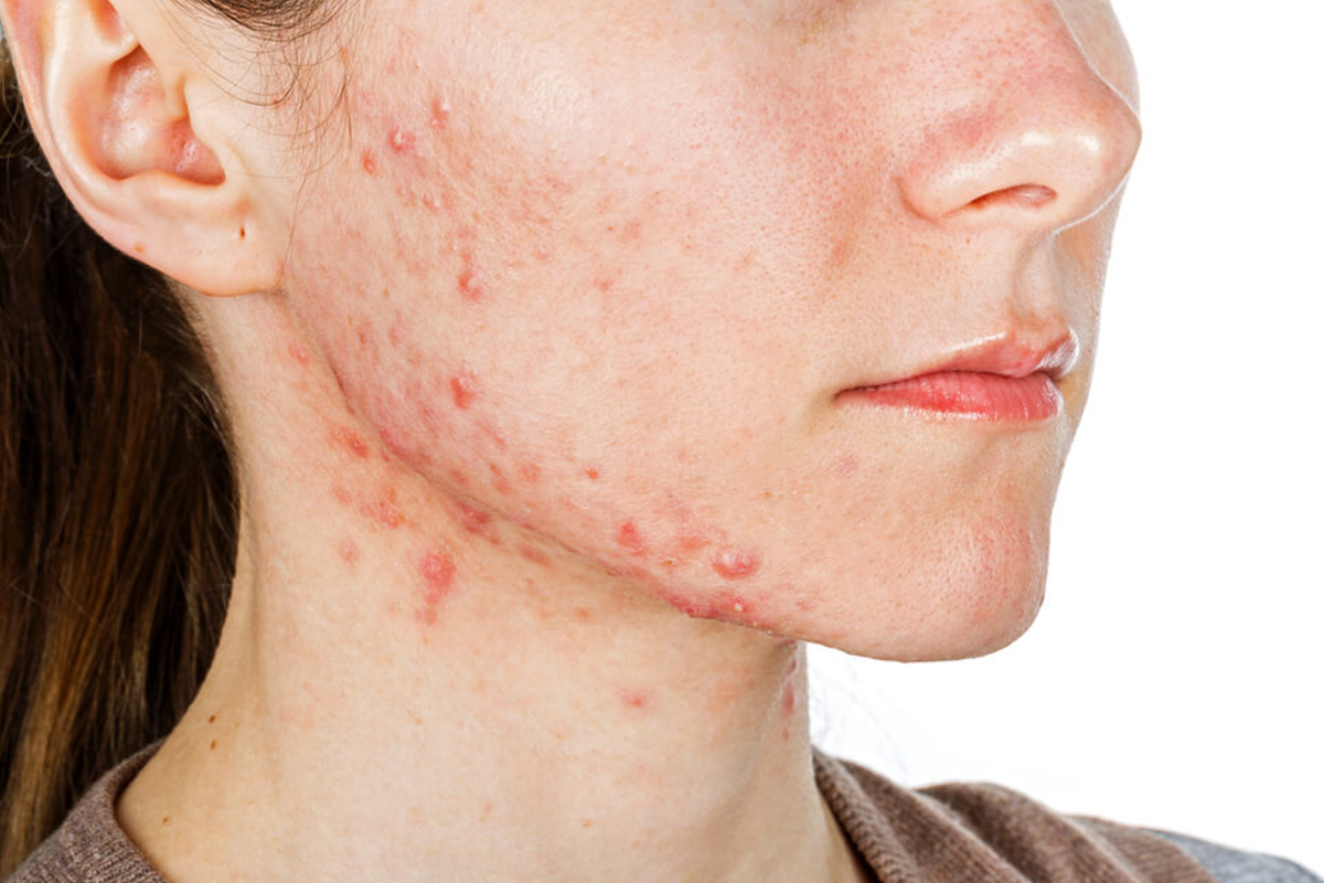 Understanding and Managing Acne in Teenagers