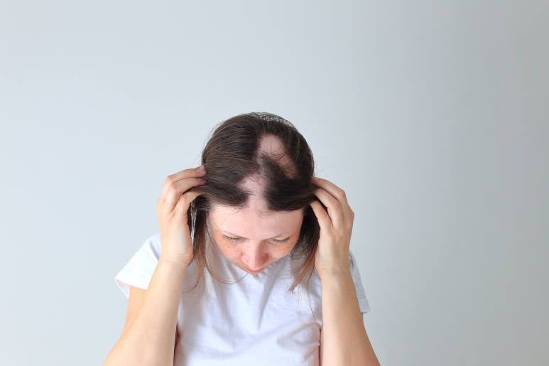 woman-with-bald-patches-from-alopecia-areata-1