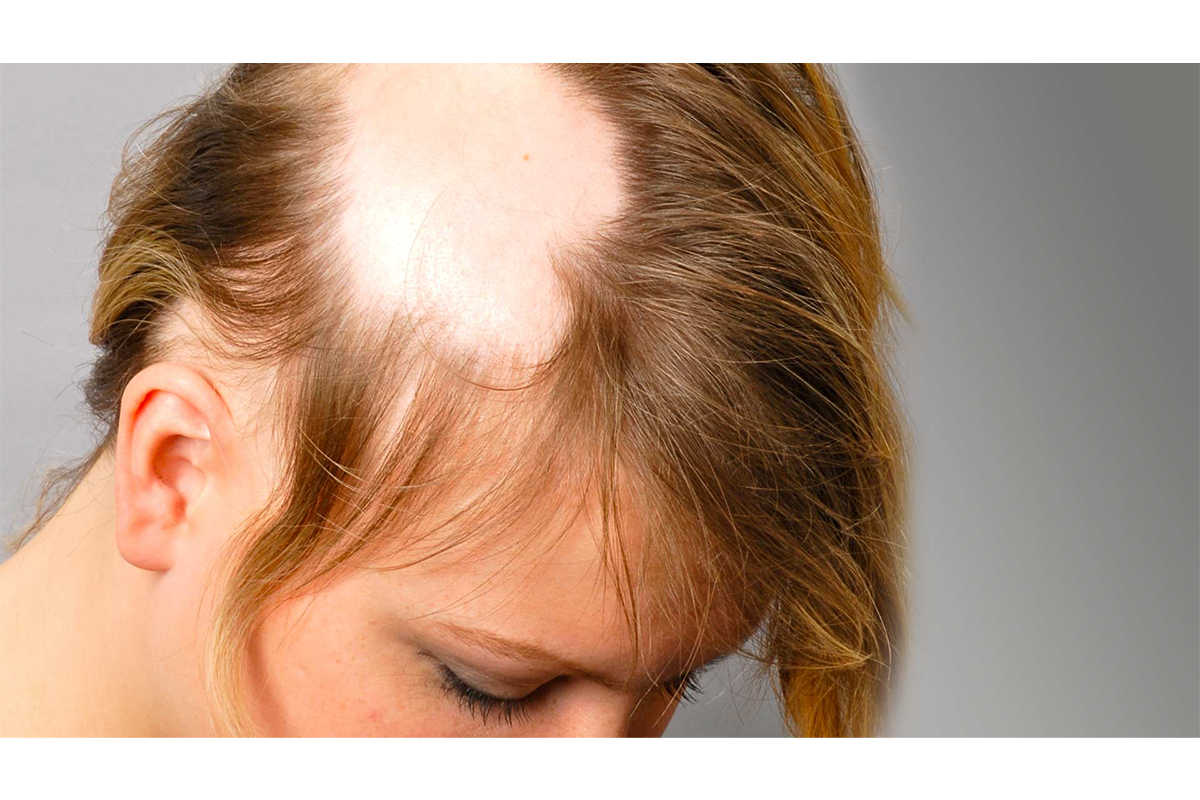 Alopecia Areata: Understanding the Condition and Exploring Treatment Options