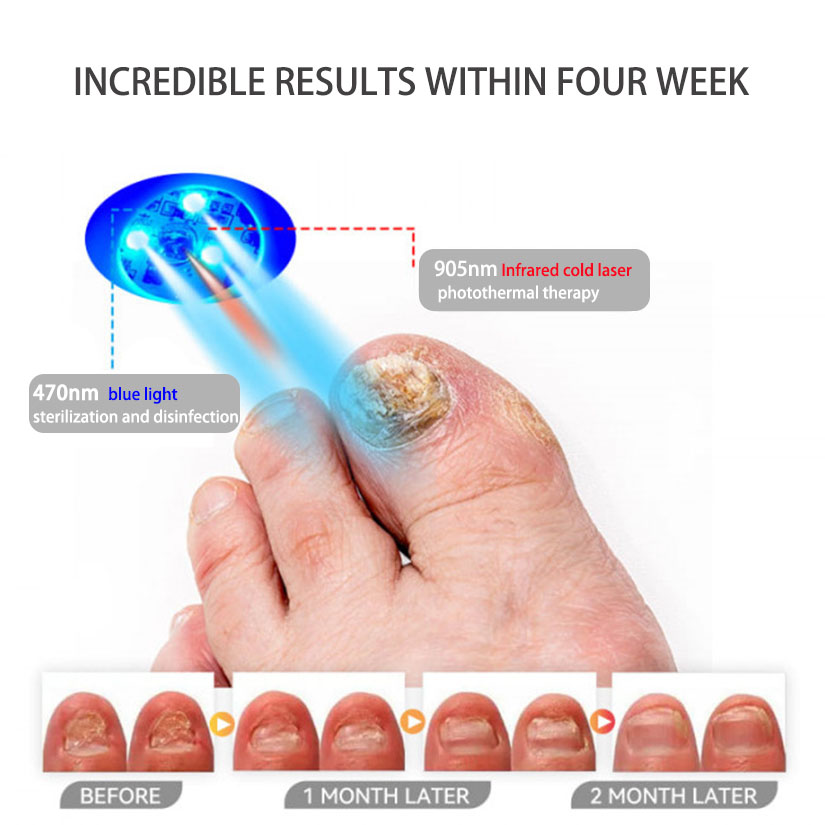 Rethinking Nail Care: How Onychom™ Is Changing the Way People Manage Fungal Nails