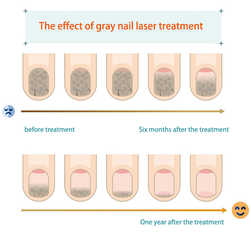 Portable Nail Anti-Fungal Laser Device vs. Traditional Treatments: What Buyers Should Know Before Choosing a Solution