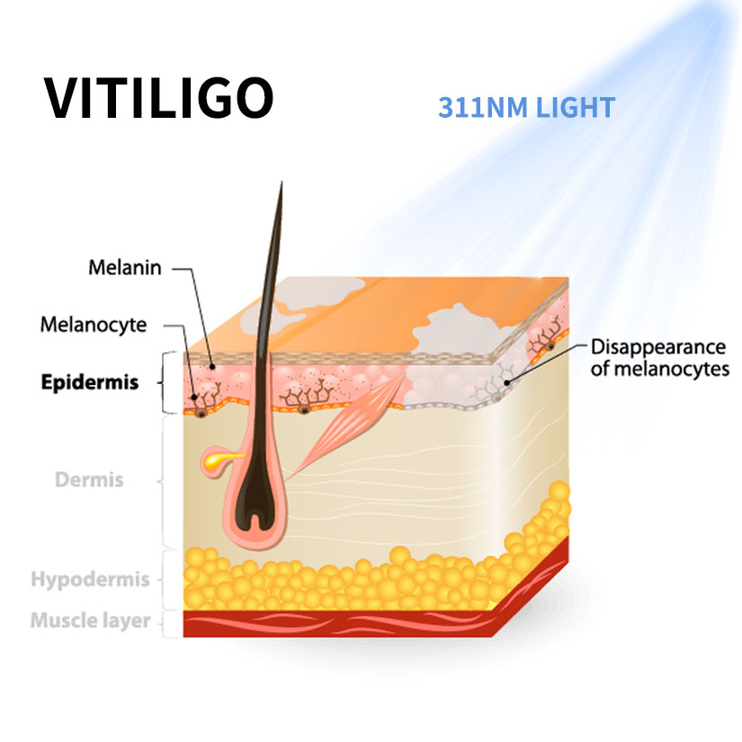 Understanding Vitiligo at the Cellular Level and the Role of 311 nm Light Therapy
